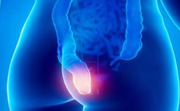 Anal fissure