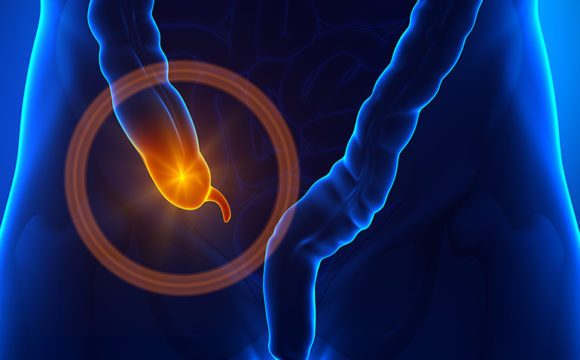 acute-appendicitis