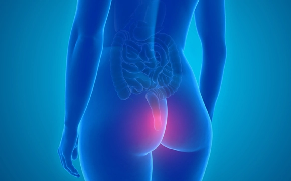 anal-fistula